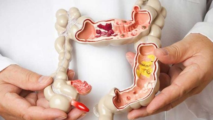 Crohn nedir? Crohn hastalığı belirtileri nelerdir?