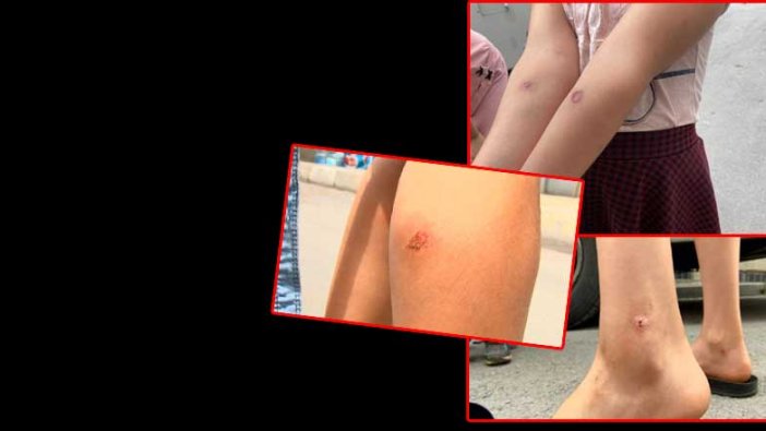 İstanbul'da sivrisinek paniği! Çocuklarda korkutan yaralar oluştu